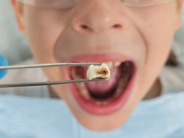 Best Broken or Chipped Tooth Repair in Perkasie, PA